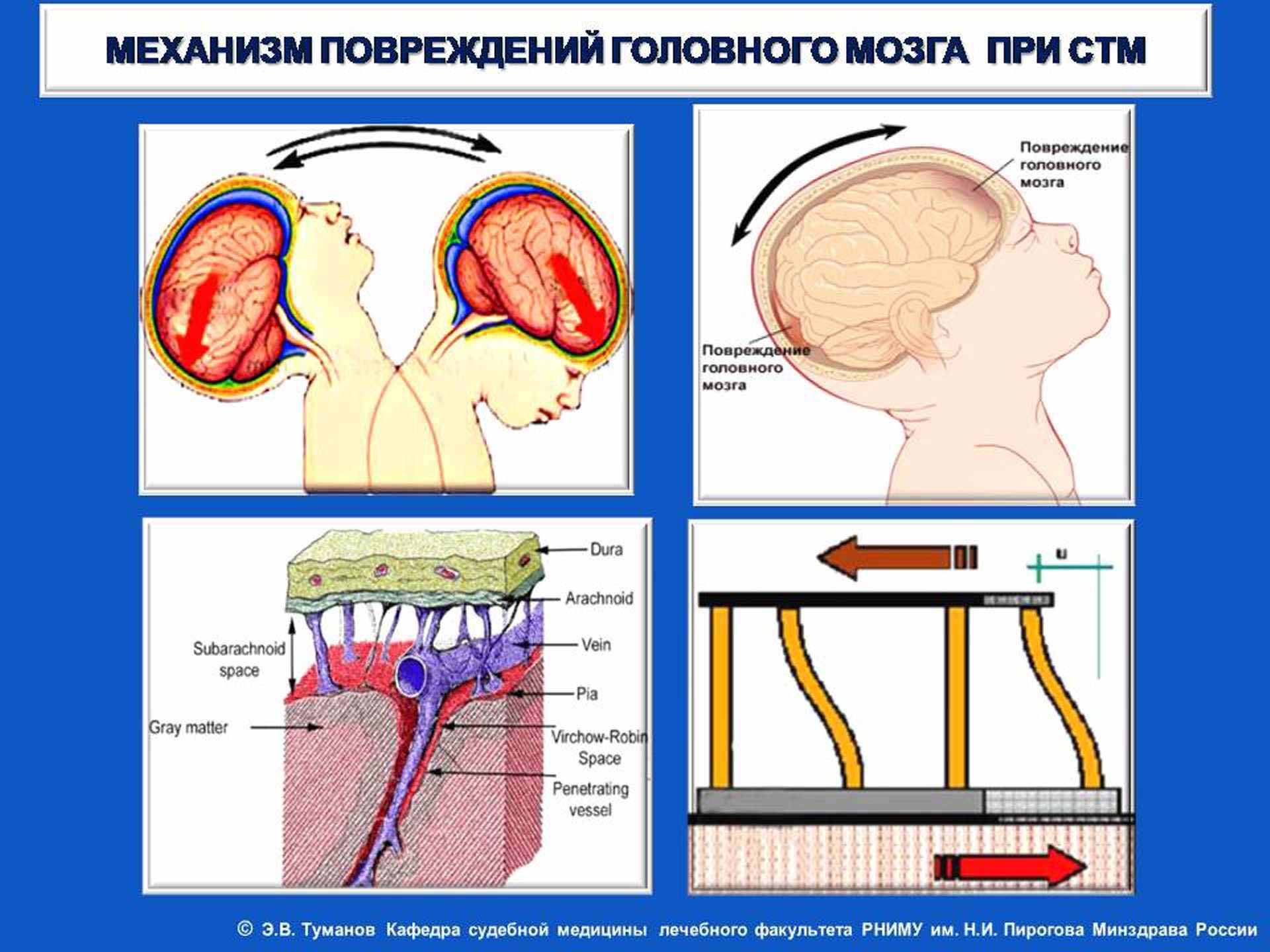 Механизм повреждений головного мозга при СТМ